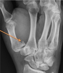 <p>fracture through base of the first metacarpal bone, extending into the CMC joint with subluxation w/ posterior displacement</p>