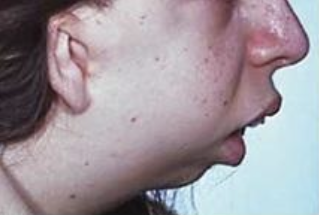 <p>What kind of skeletal deformity is shown in this figure?</p><p>A. Mandibular Prognathism </p><p>B. Maxillary Prognathism </p><p>C. Bilateral Retrognathism </p><p>D. Mandibular Retrognathism</p>