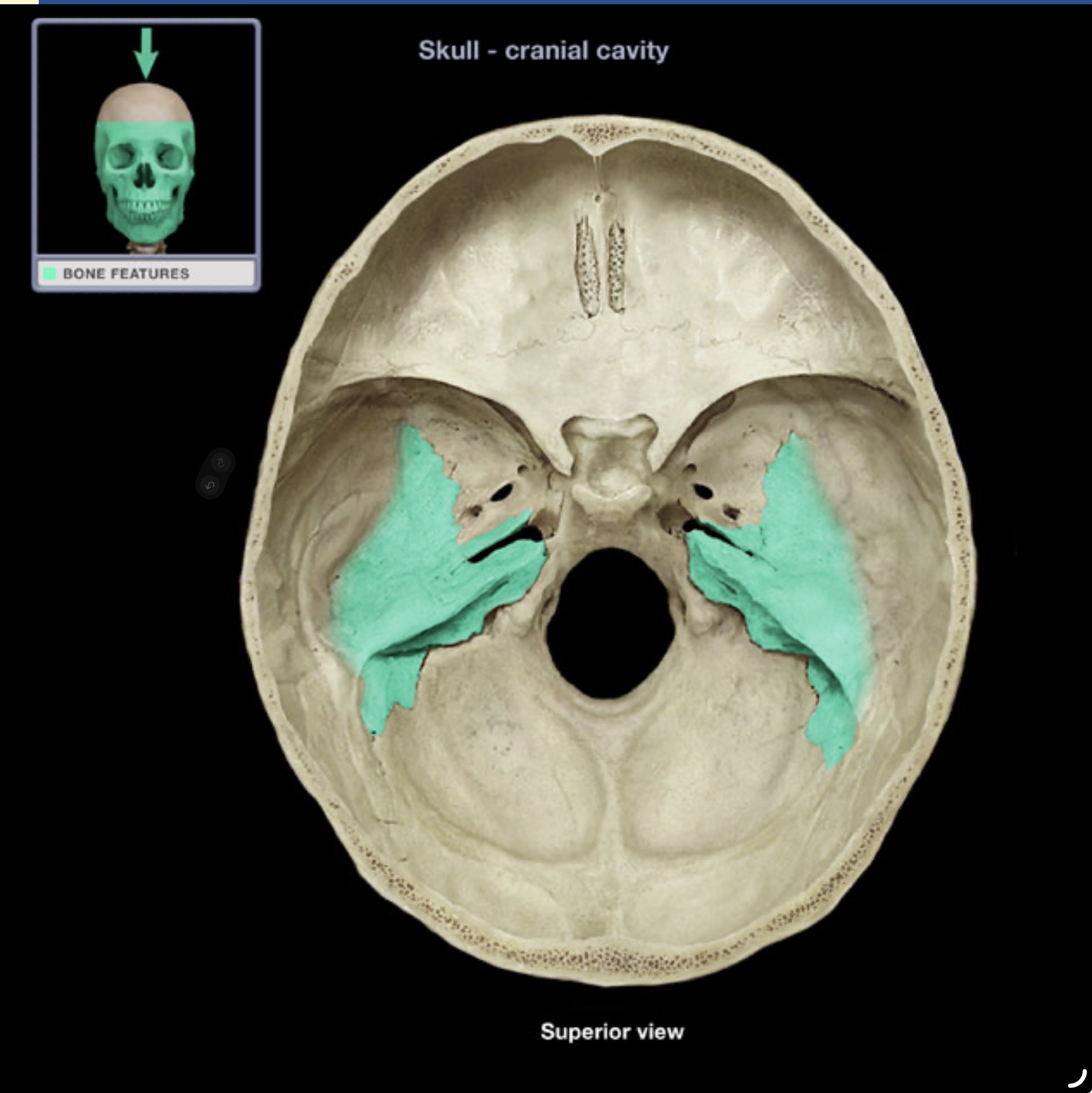 <p>A dense bony ridge on the interior surface of the temporal bone, location of middle and inner ear cavities.</p>