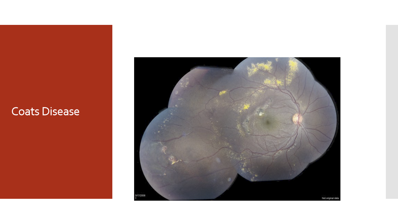 <ul><li><p>Retinal telangiectasias (abnormal retinal vessels) cause intraretinal and subretinal exudation</p></li><li><p>Progressive exudation can lead to exudative retinal detachment (RD)</p></li></ul><p></p>