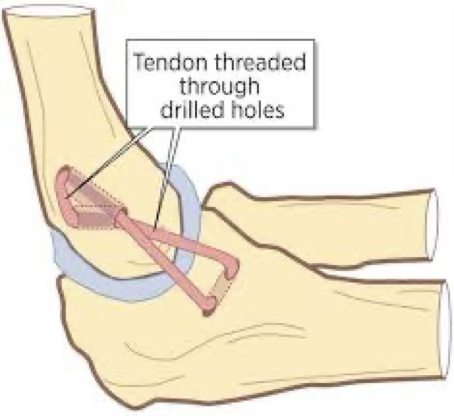 <p>symptoms of UCL sprain</p>