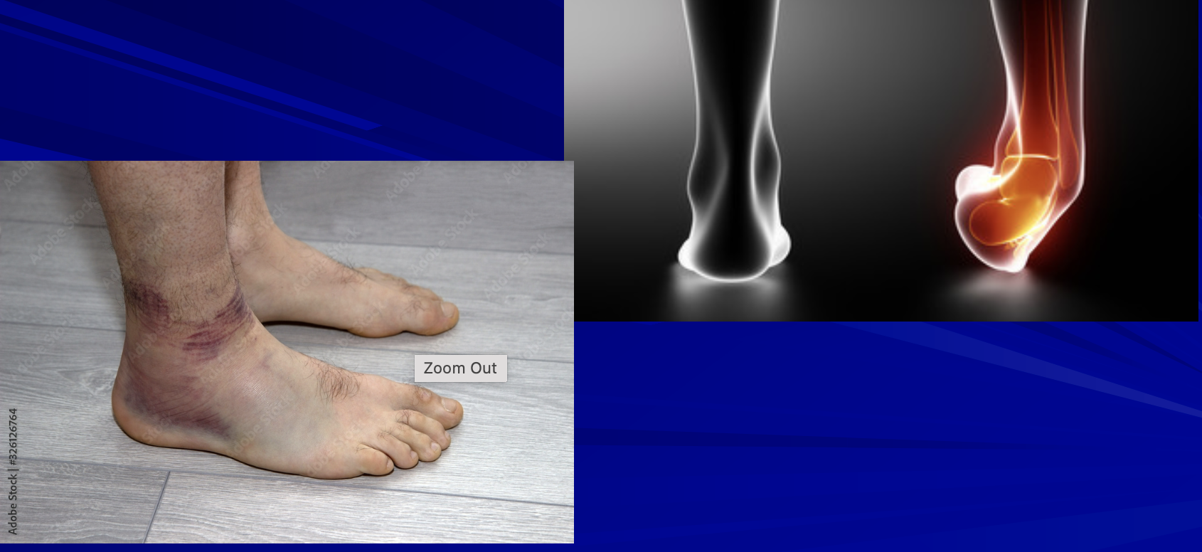 <p>3 types of ankle sprains and which one is the most likely to be injured?</p>