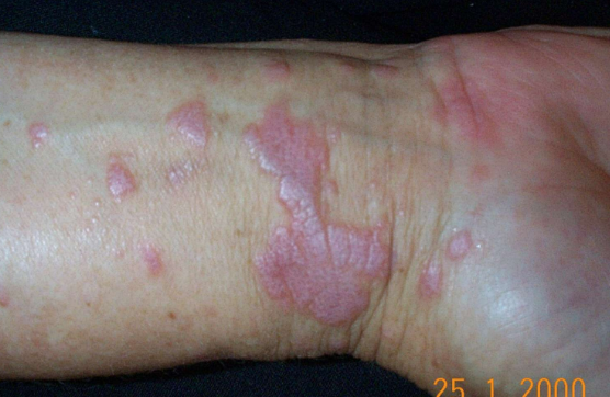 <p>disk shaped, elevated lesion wider than 1 cm </p>
