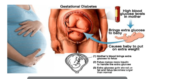 <ul><li><p>2-10% of pregnant women</p></li><li><p>due to high blood glucose that develops during pregnancy</p></li><li><p>temporary but can increase the risk of the mother and child developing diabetes later on in life</p></li></ul><p></p>