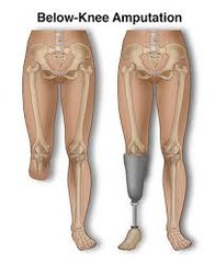 <p>below knee amputation</p>