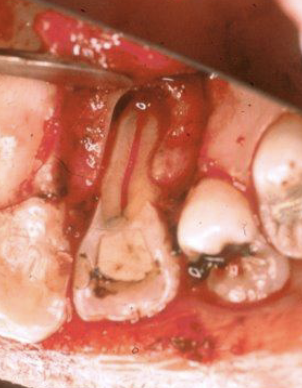 <p>What is the anatomical variation in this lateral incisor?</p>