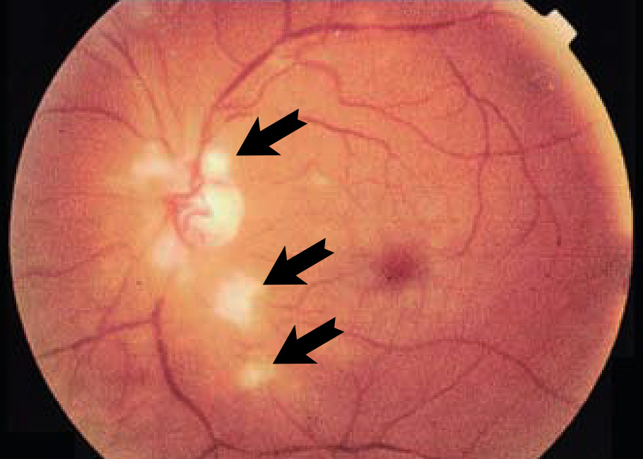 <p>abnormal soft exudates visible as fray white areas on the ocular fundus </p>