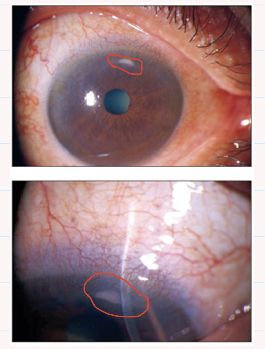 <ul><li><p><strong>shallow ulcer</strong></p></li><li><p>Round, arcuate , single or multiple</p></li><li><p>usually parallel to limbus but separated by clear corneal zone</p></li><li><p><mark data-color="green" style="background-color: green; color: inherit;">stains with fluorescein</mark></p></li><li><p>Hyperaemia + <mark data-color="green" style="background-color: green; color: inherit;">oedema of adjacent bulbar conjunctiva</mark></p></li><li><p>NO AC involvement</p></li></ul><p></p>