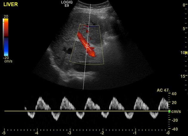 <p>Prominent diastolic flow and weak systolic flow. Differential includes right sided heart failure and tricuspid regurgitation. In this case, tricuspid regurgitation.</p>