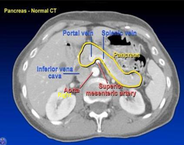 <ul><li><p>tail → @ splenic hilum</p></li><li><p>head → @ IVC</p></li><li><p>body → @ aorta + SMA</p></li></ul><p></p>