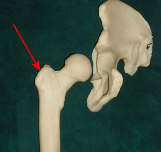 <p><span>This picture shows the right hip bone and femur. A muscle that originates from the ilium and inserts at the arrow would act to?</span></p>