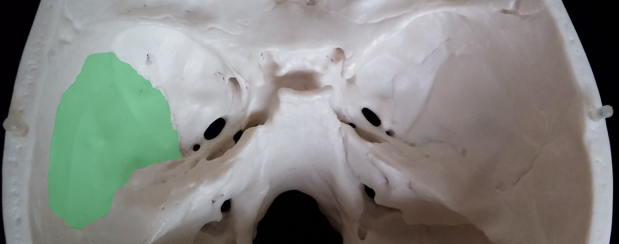 <p>What is the green region highlighted on the temporal bone?</p>