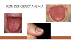 <p>what are som unique manifestations of iron deficiency anemia?</p>