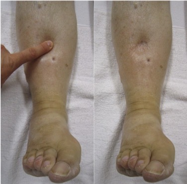 <p>Accumulation of fluid in interstitial space (pitting edema)</p><ul><li><p>causes Hyponatremia</p></li></ul><p></p>