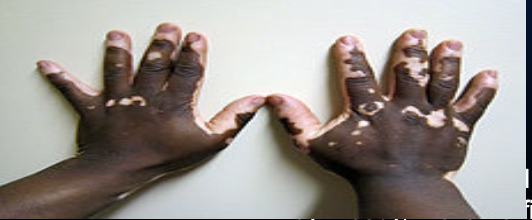 <p>Depigmentation of the skin due to loss of melanocytes.</p>