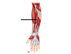 <p>O: medial epicondyle of humerus </p><p>I: 2nd/3rd metacarpal</p>