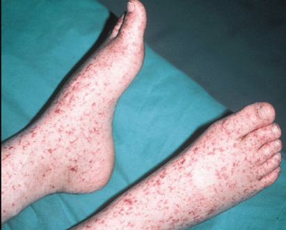 <p>Which tick species is associated with Rocky Mountain Spotted Fever?</p>