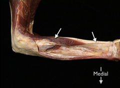 <p>In this posterior view of a partially dissected right forearm, identify the muscle indicated by the arrows.</p>