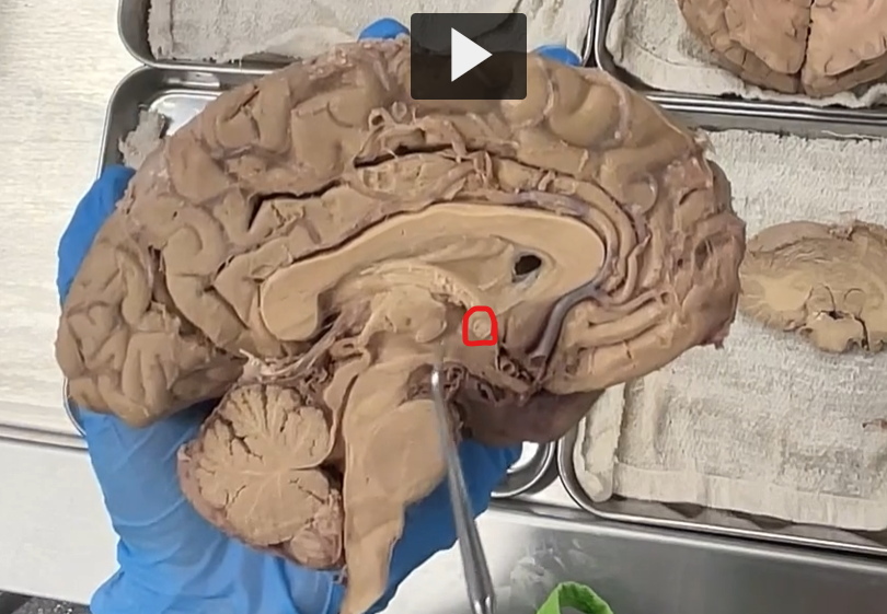 <p>anterior commissure</p><p><strong>Anterior Commissure — Etymology &amp; Definition</strong> </p><p><strong>Etymology</strong> </p><ul><li><p><strong>Latin roots:</strong></p><ul><li><p><strong><em>anterior</em></strong> = “front”</p></li><li><p><strong><em>commissura</em></strong> = “joining together” (<em>com-</em> = together + <em>mittere</em> = to send)</p></li></ul></li></ul><p>So, <strong><em>anterior commissure</em> literally means “front connection.”</strong></p><p>  <strong>Definition (Neuroanatomy)</strong> </p><ul><li><p>The <strong>anterior commissure</strong> is:</p><ul><li><p>A <strong>small bundle of commissural fibers</strong></p></li><li><p><strong>Located</strong> in the <strong>anterior (front) part of the brain</strong></p></li><li><p>Connects parts of the <strong>left and right hemispheres</strong>, especially regions of the <strong>temporal lobes</strong></p></li></ul></li></ul><p></p>