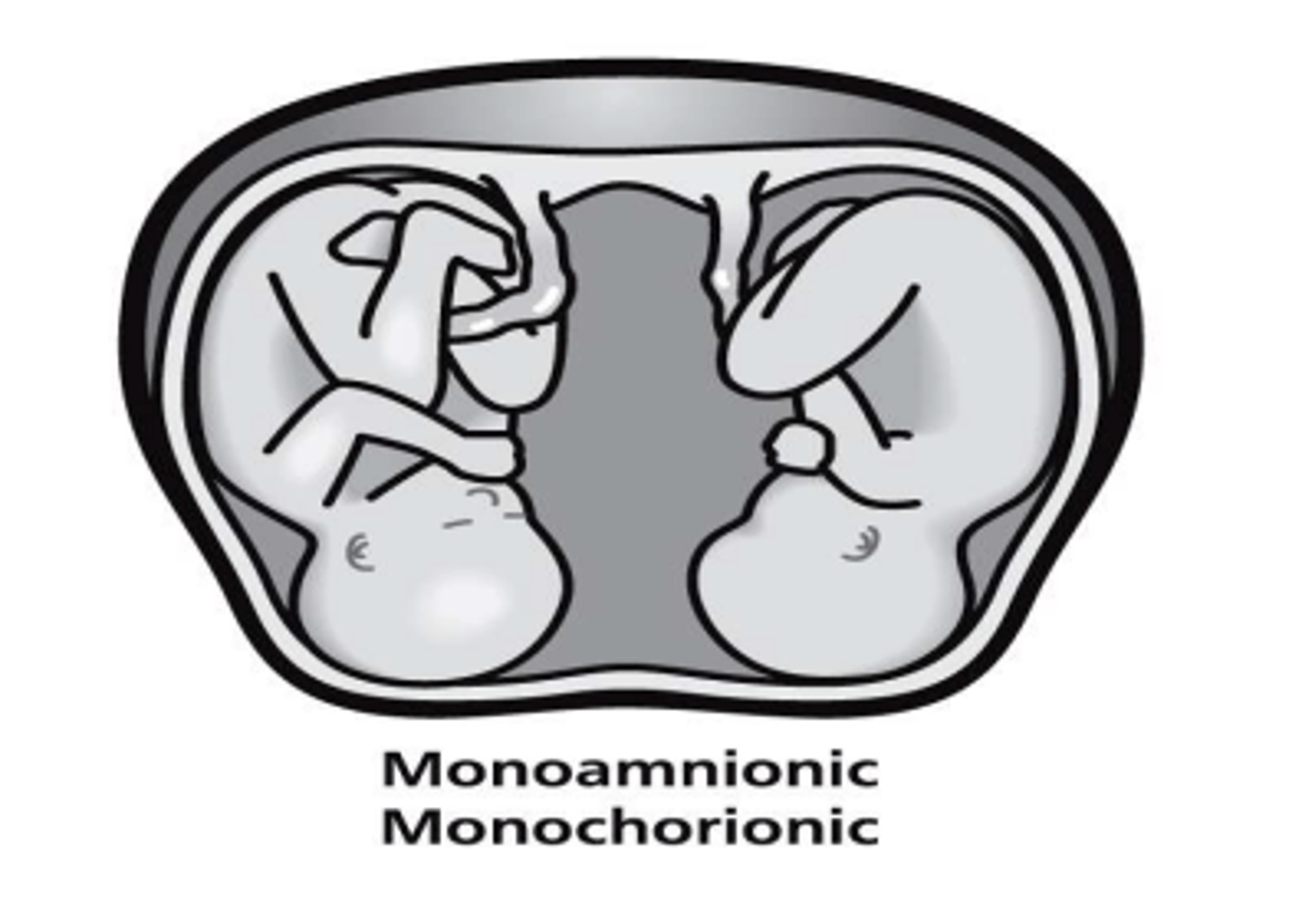<p>1 placenta/ 1 amnion/ 1 chorion; concern for cord entanglement</p>