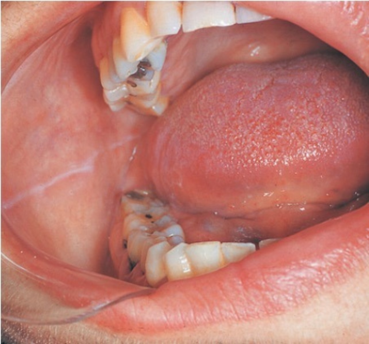 <p>chronic (long-term) friction between your teeth and the lining of your cheek, also known as your buccal mucosa</p>