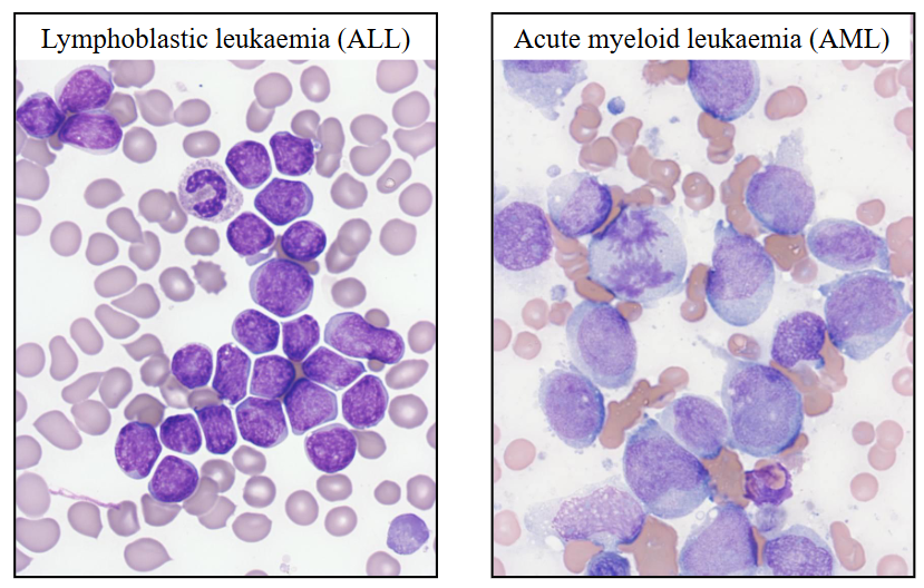 <p>Morphology of Acute Leukaemia</p>