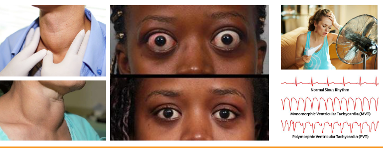 <p>•Heat intolerance, sweating, anxiety, tremor</p><p>•Weight loss despite increased appetite present</p><p>•Tachycardia, hypertension, cardiac strain risk</p><p>•Exophthalmos with protruding eyes characteristic</p><p><strong>•Oral burning, caries, perio risk increased</strong></p>