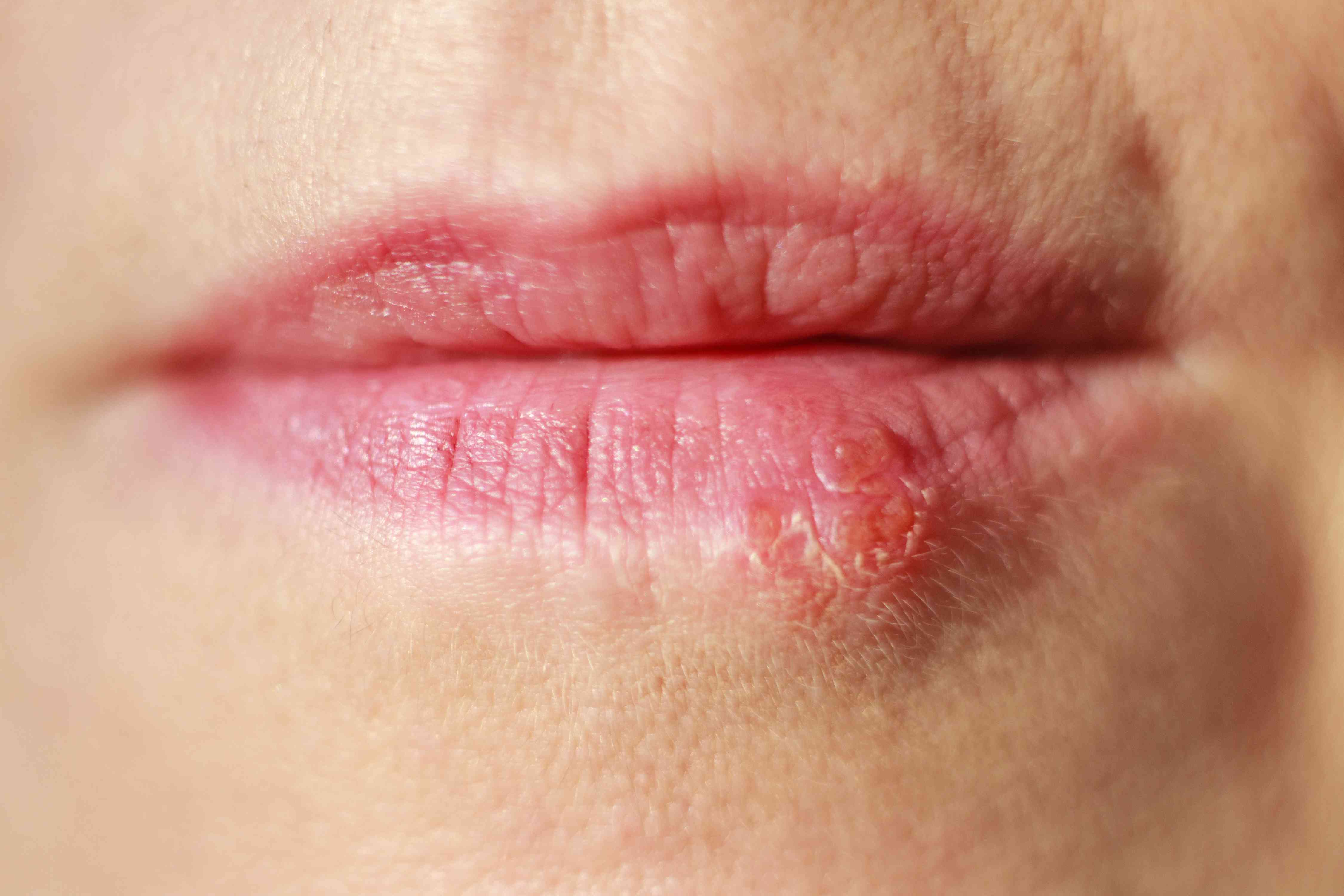 <p><span>are </span><strong><mark data-color="rgba(0, 0, 0, 0)" style="background-color: rgba(0, 0, 0, 0); color: inherit;">small, contagious, fluid-filled blisters on or around the lips caused by the herpes simplex virus (HSV), typically HSV-1</mark></strong><span>. They are a symptom of an oral herpes infection. Once infected, the virus stays in the body for life, often lying dormant but capable of reactivating.</span></p>