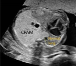 <ul><li><p><span style="color: red;">heart is displaced further toward</span> the <span style="color: red;">left chest</span>, usually in association with space-occupying lesion</p></li></ul><p></p>