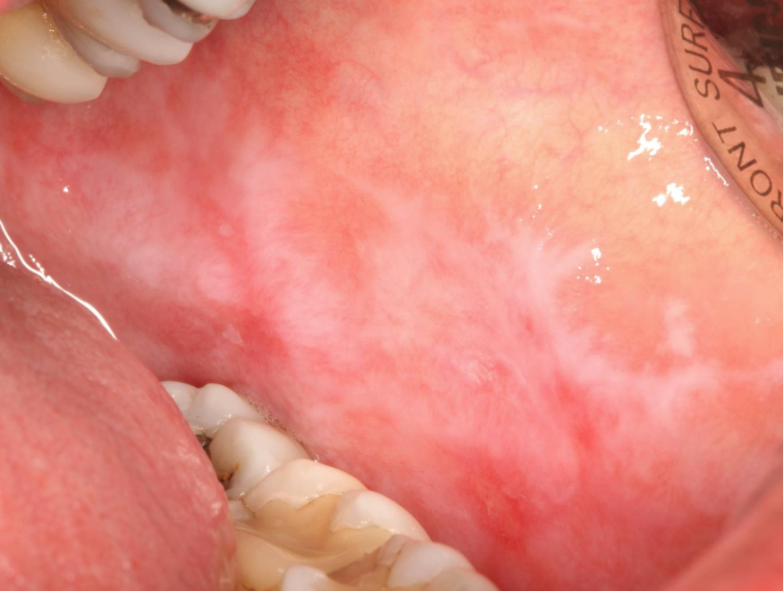 <p>lichen planus (reticular)</p>