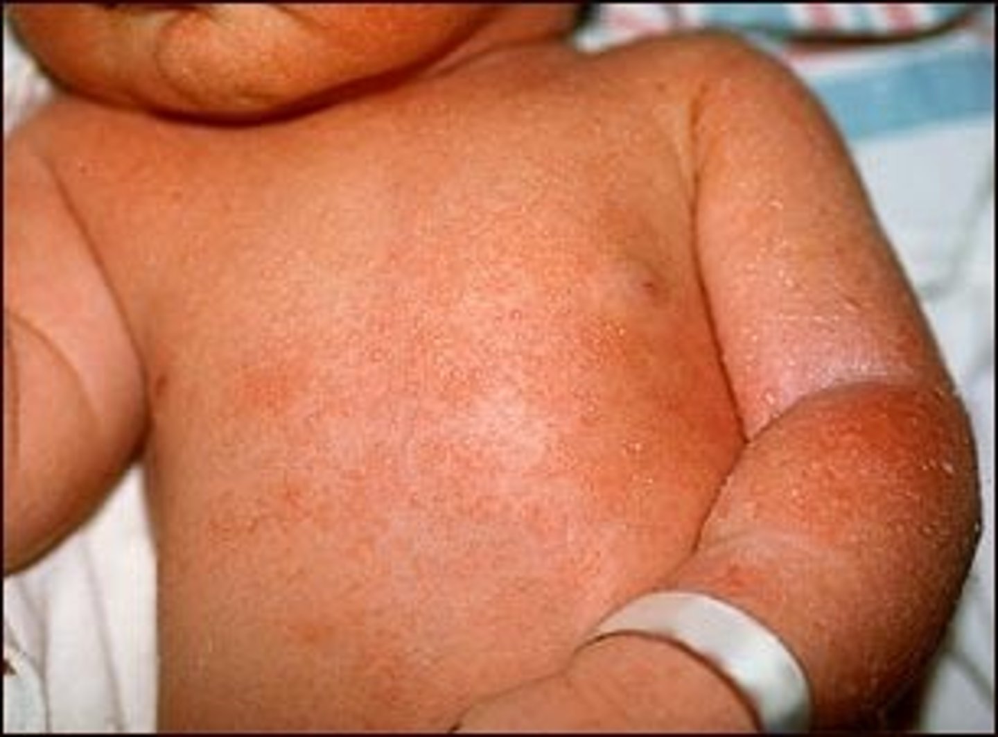 <p>known as prickly heat, an acute inflammatory disorder of the sweat glands, characterized by the eruption of small red vesicles and accompanied by burning, itching skin.</p>