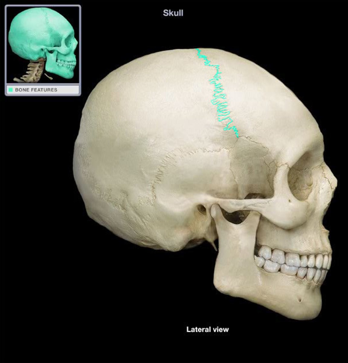 <p>junction between frontal and parietal bones</p>