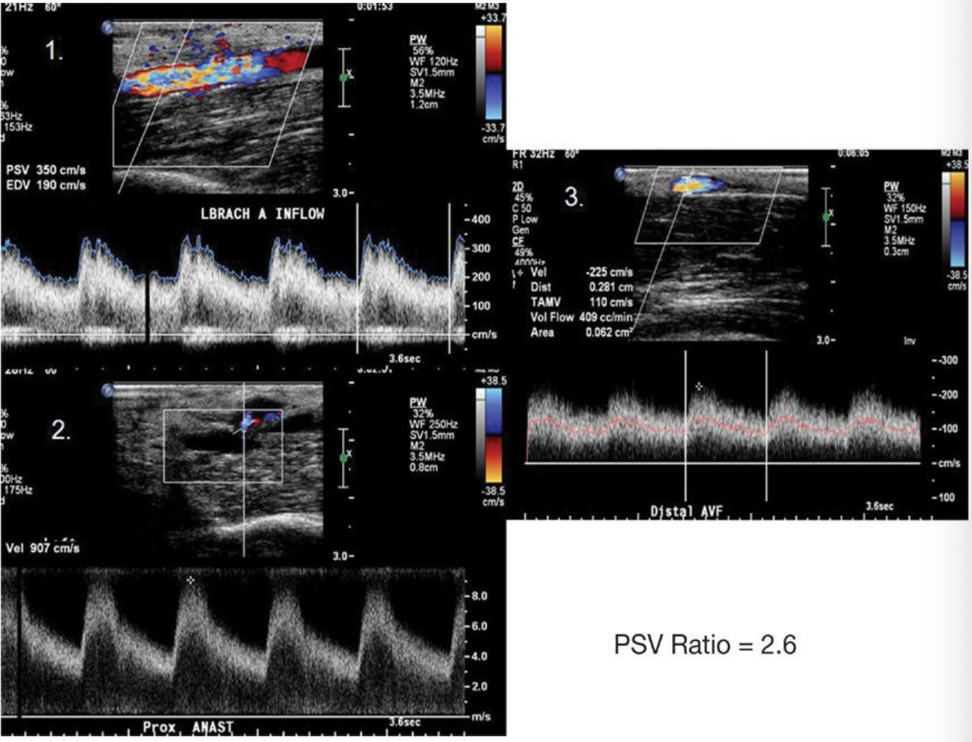 <p>The images in Figure 4–54 were obtained from a patient in order 1, 2, and 3 from proximal to distal in an upper extremity arterial venous fistula. What is your diagnosis based on these findings?</p><p>(A) Normal</p><p class="p1">(B) <50% stenosis at the anastomosis</p><p class="p1">(C) >50% stenosis at the anastomosis</p><p class="p1">(D) Occlusion at the anastomosis</p>