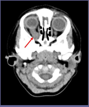 <ul><li><p>neurofibromatosis (NF) genetic disorder</p></li></ul><p></p>