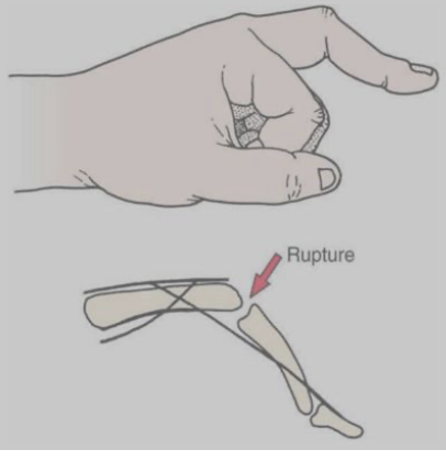 <p>Boutonniere Deformity</p>