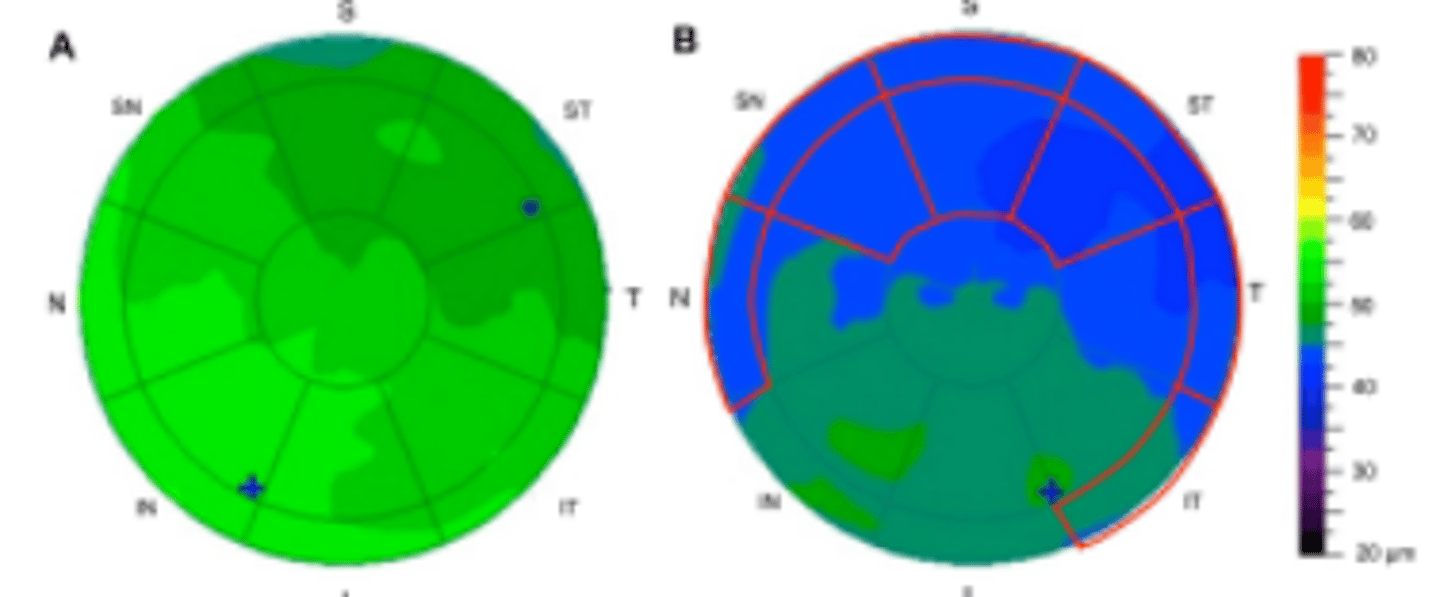 <p>Corneal epithelial thickness mapping of a cornea having dry eye may show _____ positively correlating with the severity of the dry eye. This is thought to be cause by increased friction between the upper lid and cornea during blinking. Has no correlation with TBUT, Schirmer testing, or severity of meibomian gland alteration.</p>