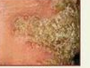 <p>What is the type of lesion and how is it defined?</p>