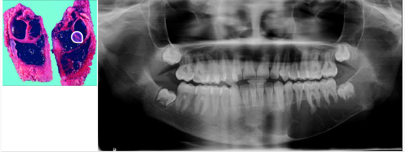 <p>aneurysmal bone cyst</p>