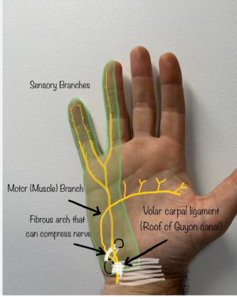 <p>Weak interossei and weak finger abduction/adduction.</p>