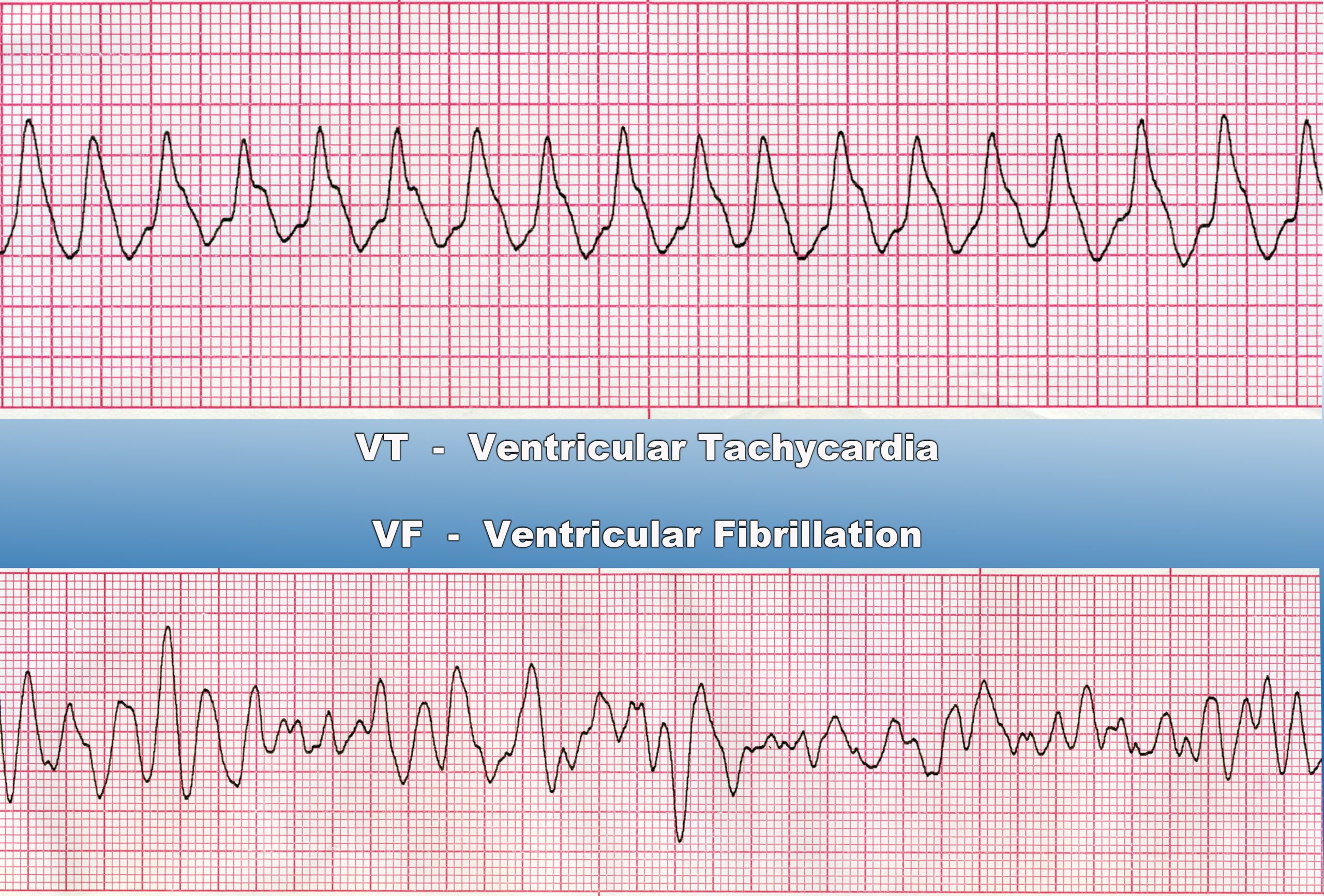 <p>pulseless Ventricular Tachycardia and Ventricular Fibrillation</p>