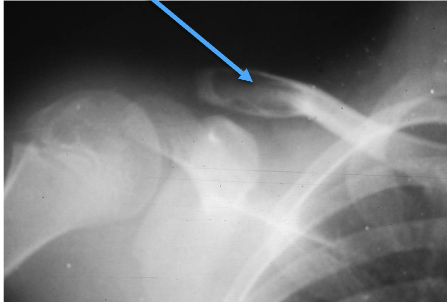 <p>What tumour-like condition is this, what bone is it in and what can be seen?</p>