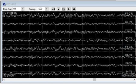 <p>Baseline EEG should look like this image here. Once the clamp goes onto the carotid artery and the timer has started, if the brain has adequate ____ without the need of a shunt, then the EEG should continue appearing stable and (symmetric/asymmetric) </p>