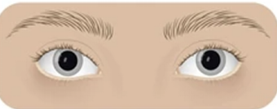 <p>dilated pupil</p>