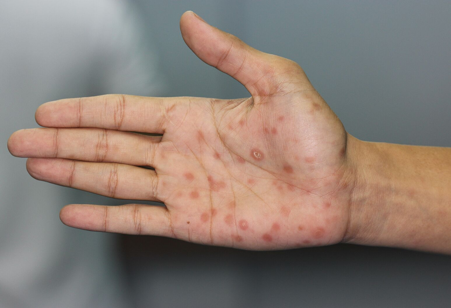 <p>What stage of syphilis is being described?</p><p>-Weeks to a few months after chancre</p><p>-Presentation: diffuse symmetrical pink-brown rash that is maculopapular and found on trunk and extremities, white erosions in the oral mucosa, fever, headache, pharyngitis, myalgias, weight loss, chorioretinitis </p>