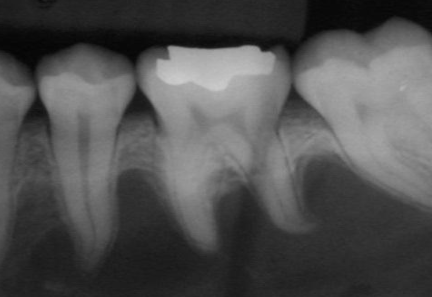 <p>Radiographic Adjacent Structures : radiolucent lesion that extends between the roots, as seen in a traumatic bone cyst (TBC)</p>