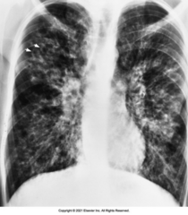 <p>This x-ray image indicates what pathology?</p>