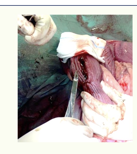 <p>Surgical technique - Uterine closure</p>