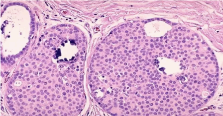 <p>What type of DCIS?</p>