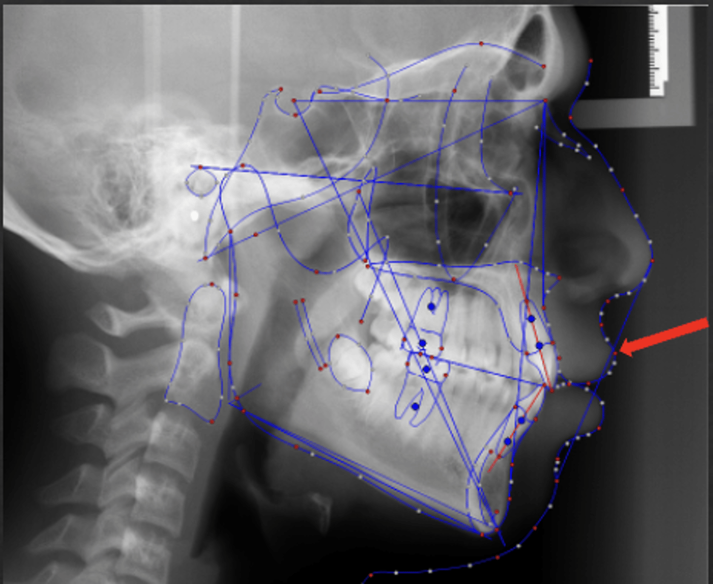 <p>which anatomical landmark:</p><p>- Most anterior point on the curve of the upper lip</p>