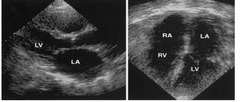 <p>What are the fibrous structures in the left ventricle as a result of chronic myocardial injury from diastolic dysfunction characteristic of?</p>